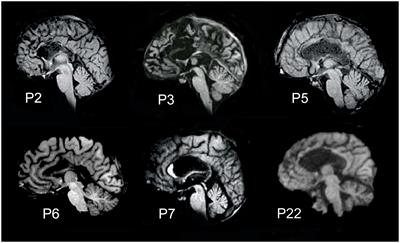 Interhemispheric functional connectivity: an fMRI study in callosotomized patients